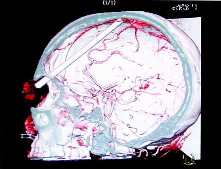 腦里插了截筷子 他還不曉得