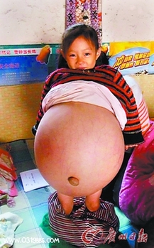 山西4歲女孩患恐怖腹水腫腹大如球 今赴京醫(yī)病