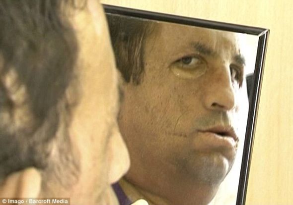 土耳其換臉人手術(shù)后首次長出胡子