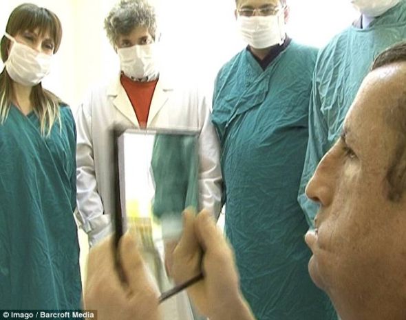 土耳其換臉人手術(shù)后首次長出胡子