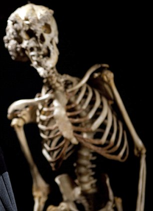 醫(yī)學“考古”將揭秘英國大象人怪癥[圖]