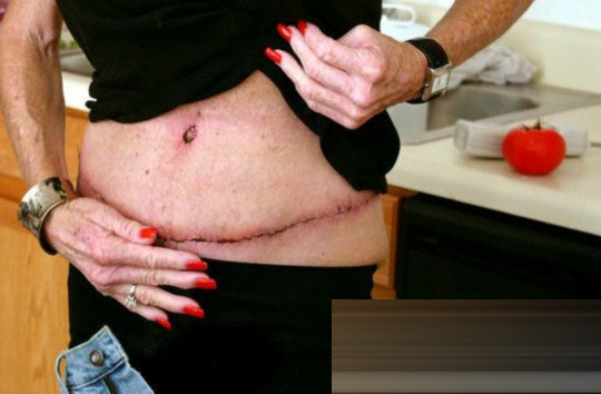 探秘國(guó)外令人觸目驚心的廉價(jià)整容