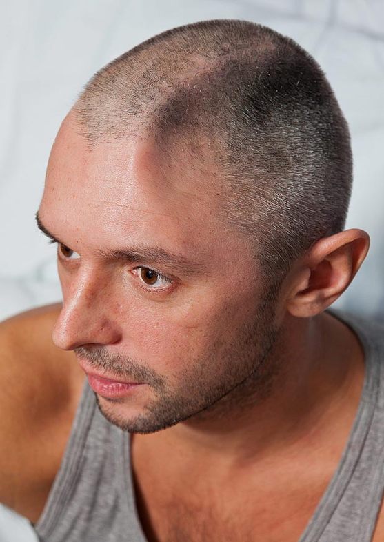 英男子陽臺墜落致1/4頭蓋骨被切(組圖)