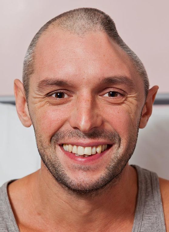 英男子陽臺墜落致1/4頭蓋骨被切(組圖)