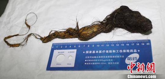 10歲女童吃8年頭發(fā) 胃中積成“頭發(fā)石”