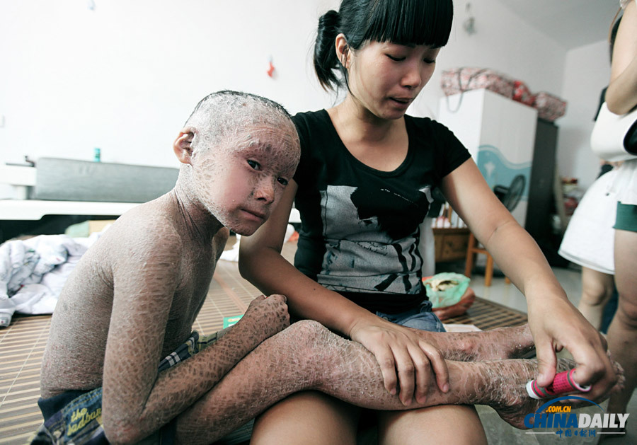 浙江溫嶺：“樹皮娃娃”渴望快樂童年