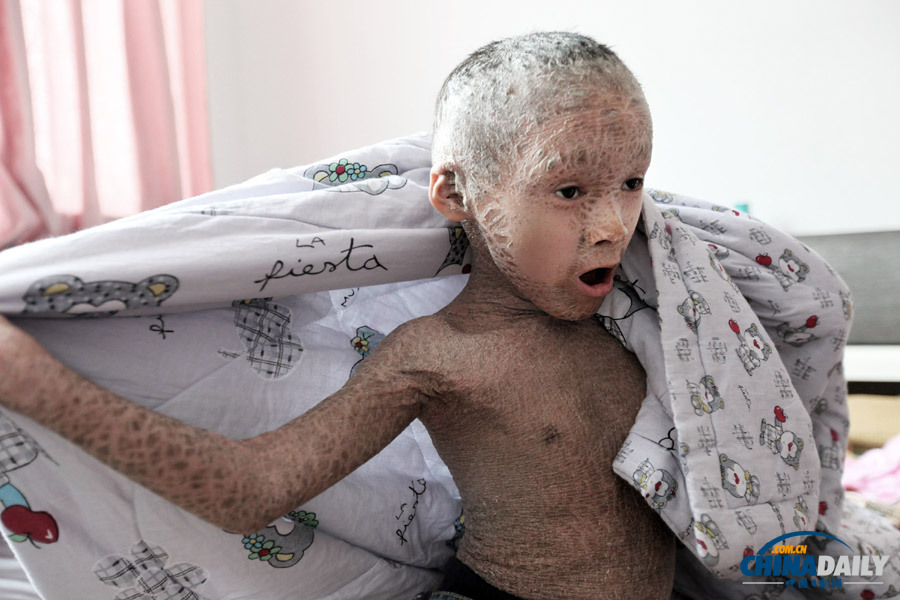 浙江溫嶺：“樹皮娃娃”渴望快樂童年