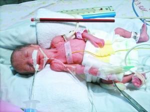 這個(gè)早產(chǎn)娃只有1.28斤 僅比普通HB鉛筆長一半