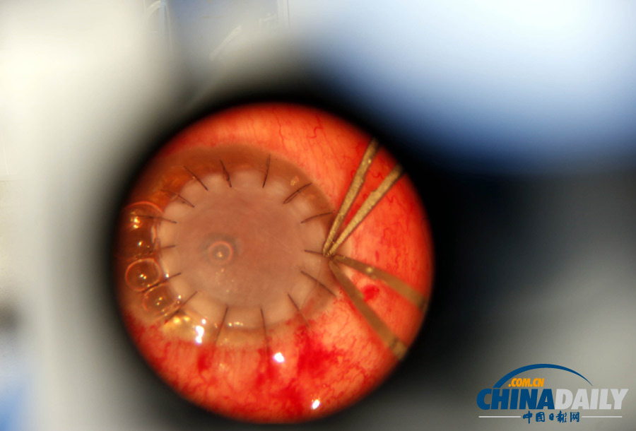 失明患者獲異國角膜“點(diǎn)亮”右眼 捐贈(zèng)者車禍過世