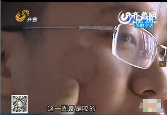 東營:男子與同事辦公室打架被咬臉 對方拒絕賠償