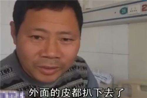 聊城兩歲半男孩雙手浸入油鍋 燙傷嚴(yán)重疼痛難耐