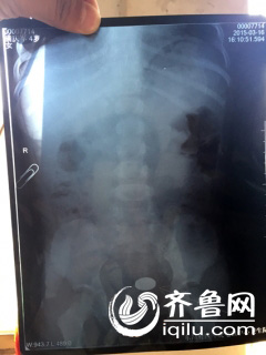 聊城:幼兒園四歲女童吞下硬幣 學(xué)生家長遭遇圍毆