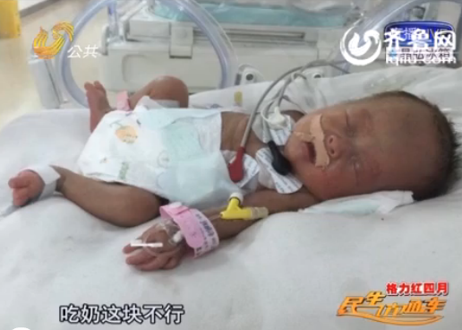 菏澤四胞胎中二女兒遭遇醫(yī)學(xué)難題 腦軟化已影響吃奶
