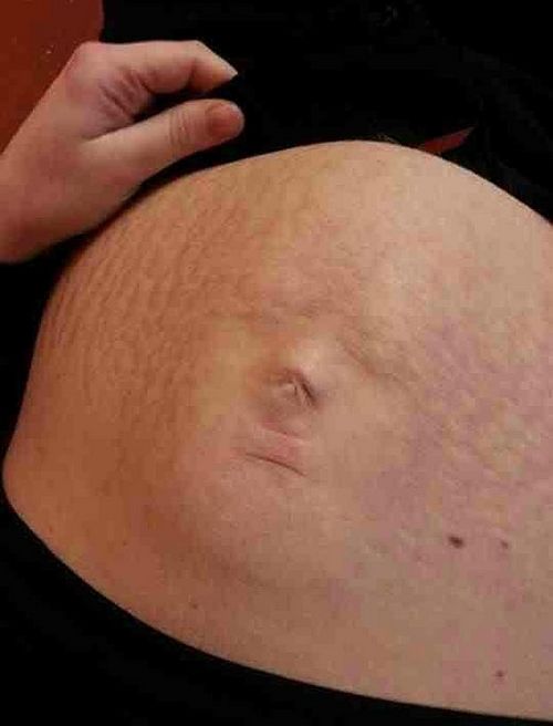 懷孕媽媽肚皮上驚現(xiàn)一張嬰兒臉（圖）