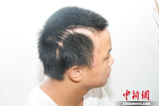 14歲男孩車禍重傷 因無力支付高額手術(shù)費(fèi)父拒認(rèn)子