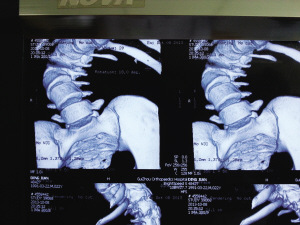 小伙患病身高僅1.26米 手術(shù)后“長(zhǎng)高”12公分(圖)