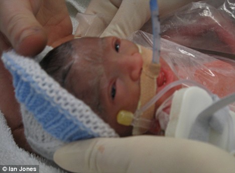 腦瘤引發(fā)腦溢血 英國(guó)女子死后兩天產(chǎn)下健康女嬰