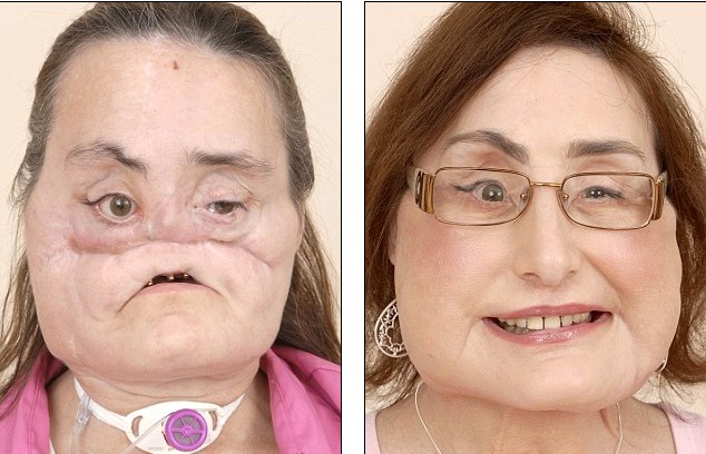 美國“換臉女”的人生奮斗 雖與兇手丈夫離婚但愛心不變