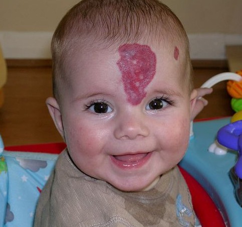 英男孩為除胎記腦門“冒出”犄角 酷似“小龍人”