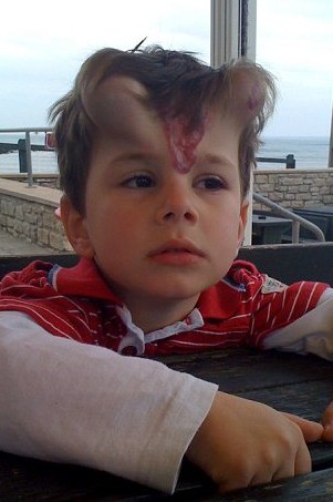 英男孩為除胎記腦門“冒出”犄角 酷似“小龍人”