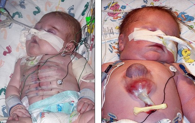 美病童“半顆心”長(zhǎng)在體外 歷經(jīng)十余次手術(shù)神奇存活