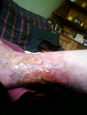 皮膚細(xì)胞也能噴涂再生？英燙傷婦女接受新療法效果神奇