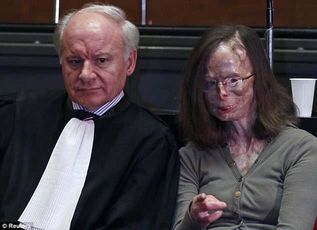 因提分手遭男友潑硫酸 比利時毀容女子勇敢出庭作證