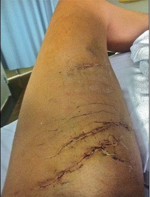 左腿被咬得死死的！23歲美女鱷魚嘴大逃生（圖片新聞）