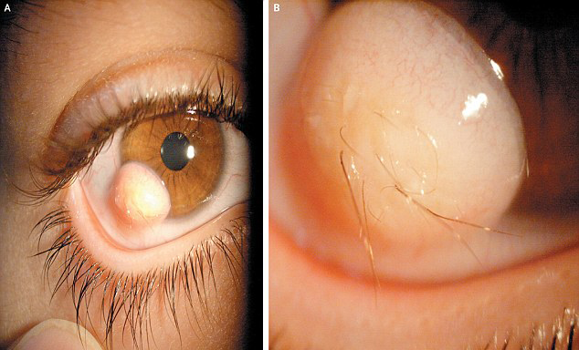 眼球上長(zhǎng)毛發(fā)！伊朗小伙眼部奇異囊腫恐怖駭人