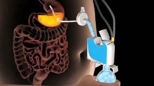 多余食物從胃里抽出？新發(fā)明讓你不擔(dān)心卡路里攝入