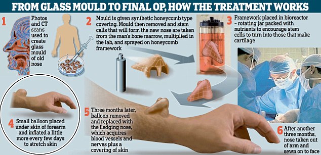 手臂上長出鼻子！人體器官再生技術(shù)獲突破