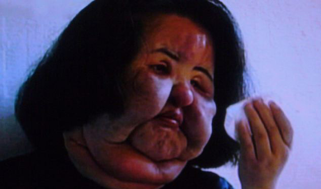 韓模特整容成癮 自行注射食用油成“站著的風扇”