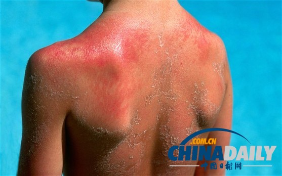 英國活動(dòng)家稱孩子曬傷家長涉嫌虐待 或受法律懲罰